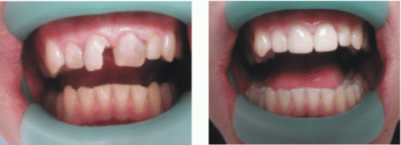 Эстетическая реставрация зубов: показания, способы, этапы